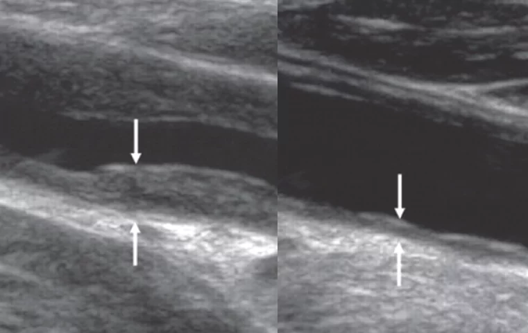 Tvärgående bilder av mina blodkärl före och efter en kurs med det innovativa botemedlet