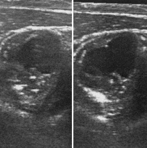 Susanne Sandberg och hennes friska artärer