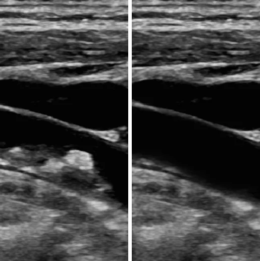 Upplösning av lipidplack
